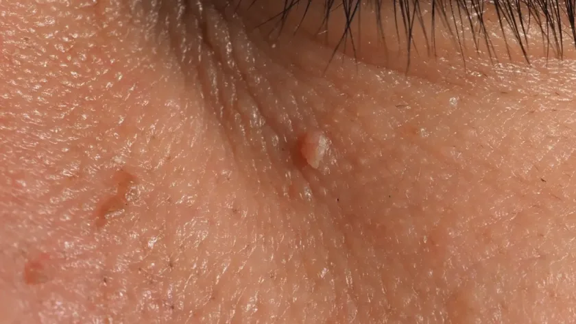 הסרת יבלות בבית, הסרת יבלות