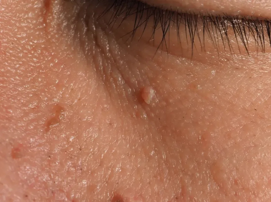 הסרת יבלות בבית, הסרת יבלות