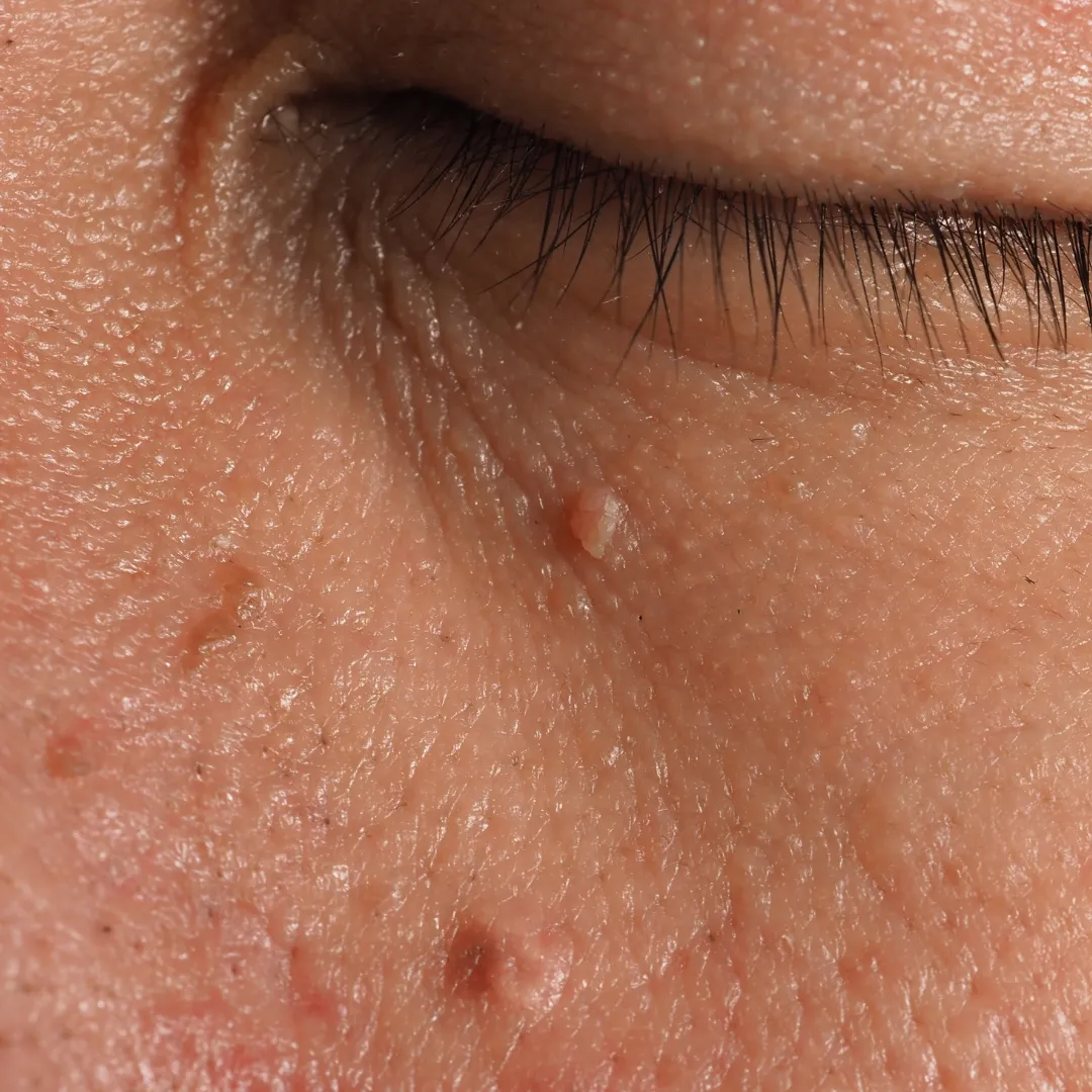 הסרת יבלות בבית, הסרת יבלות