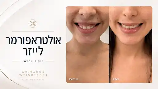 תוצאות לפני ואחרי טיפול אולטראפורמר.